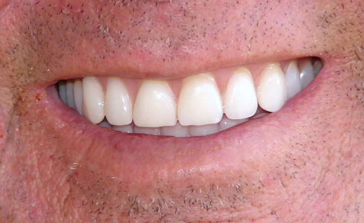 brand-new-teeth