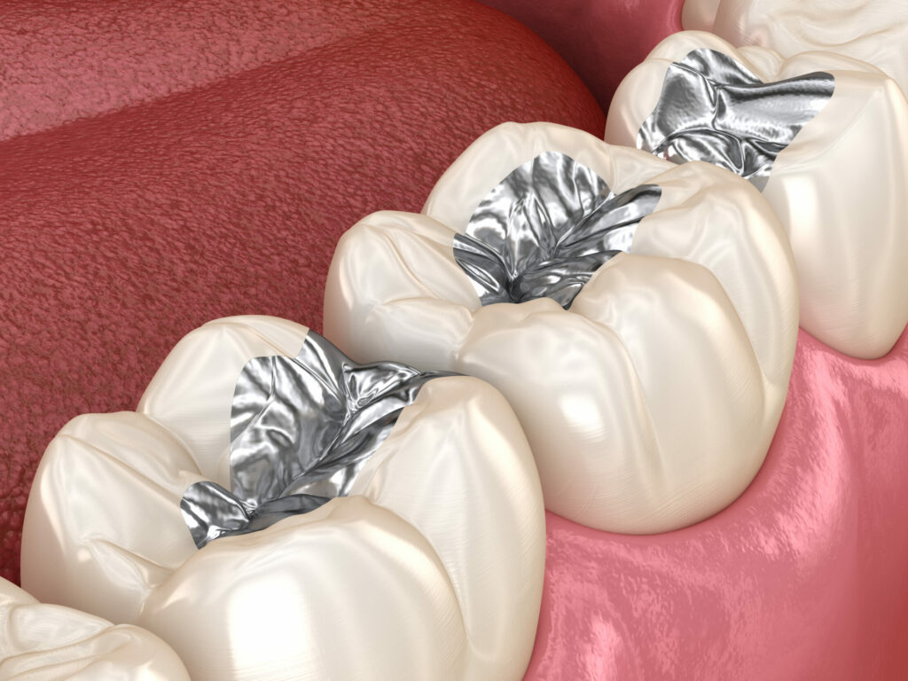 Metal Fillings and limitations of composites