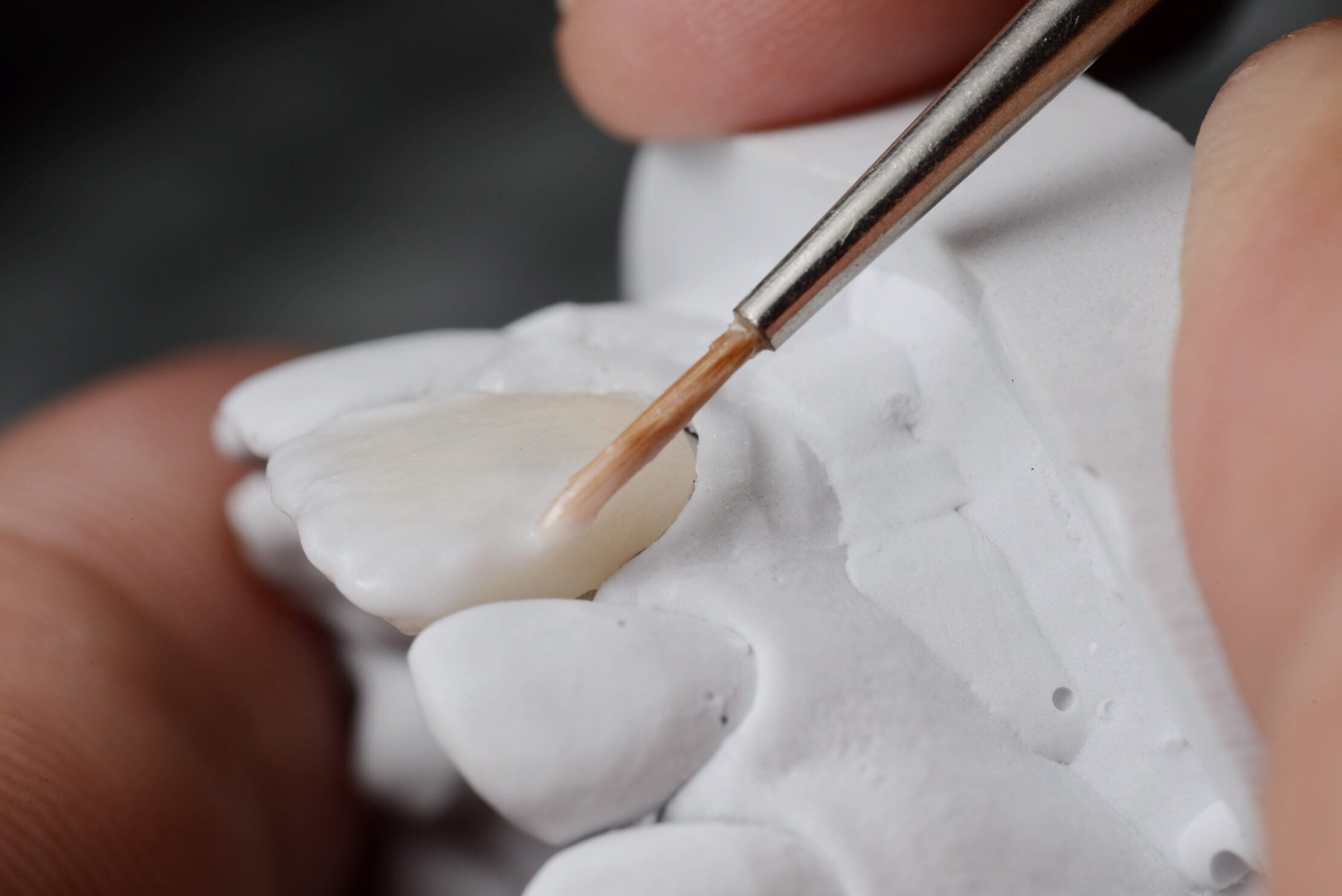 The Benefits of Dental Bonding: A Cost-Effective Solution for Your Smile