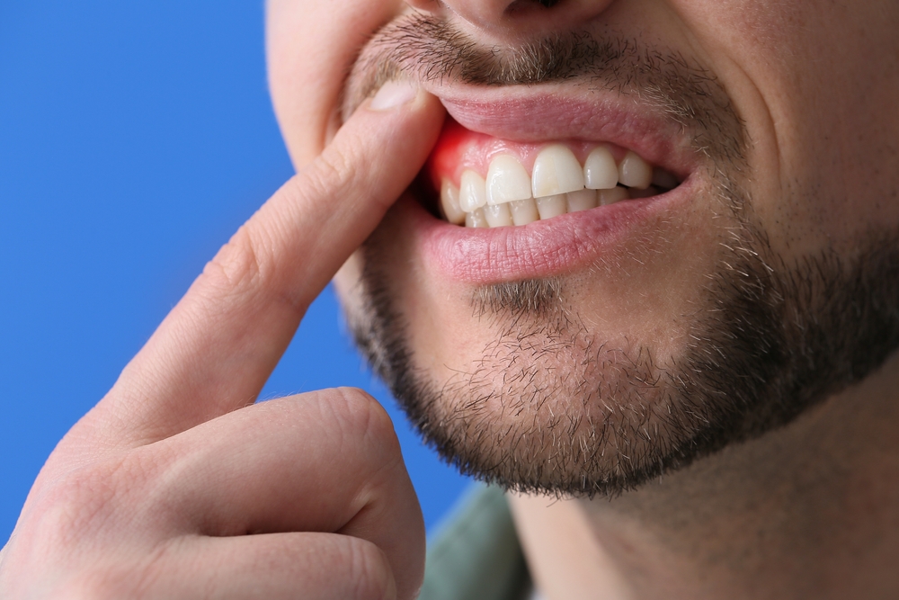 male with gum disease