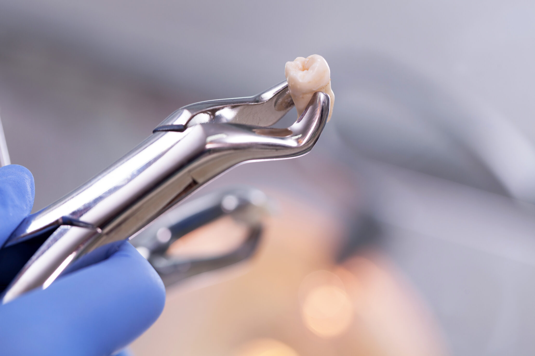 Preparing for Tooth Extraction? Tips for a Pain‑Free Recovery