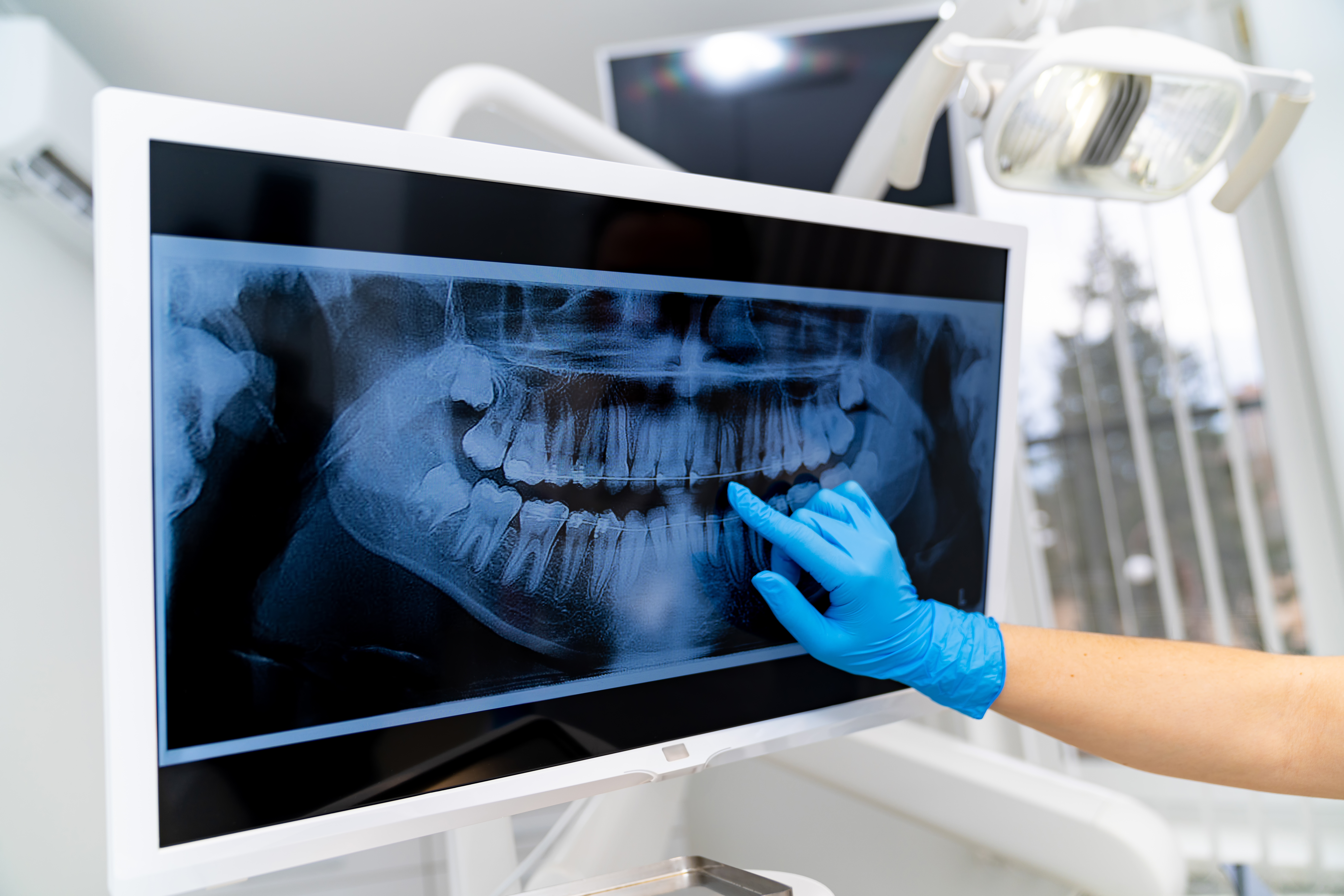 Digital Dental Care in Methuen: How Intraoral Cameras and Digital X-Rays Help Protect Your Smile