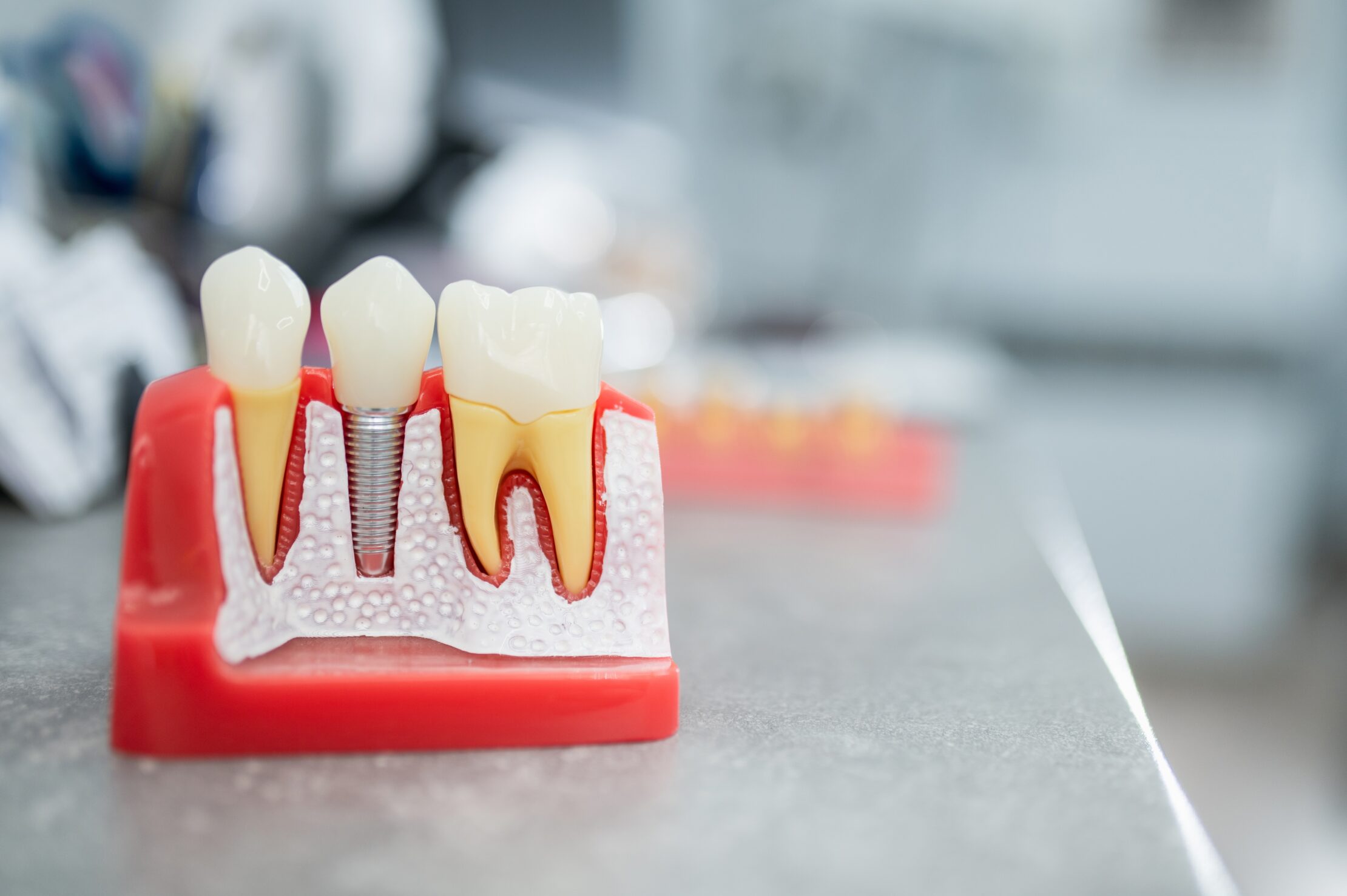 How Much Does a Dental Implant Cost in Massachusetts in 2026?